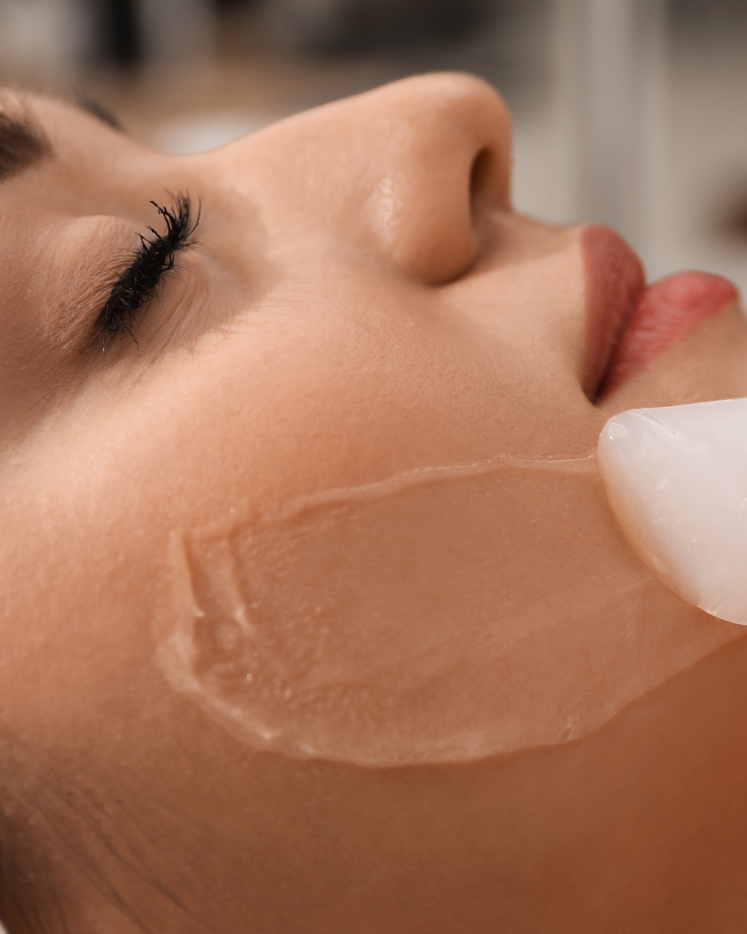 Chemical Peel — About the treatment